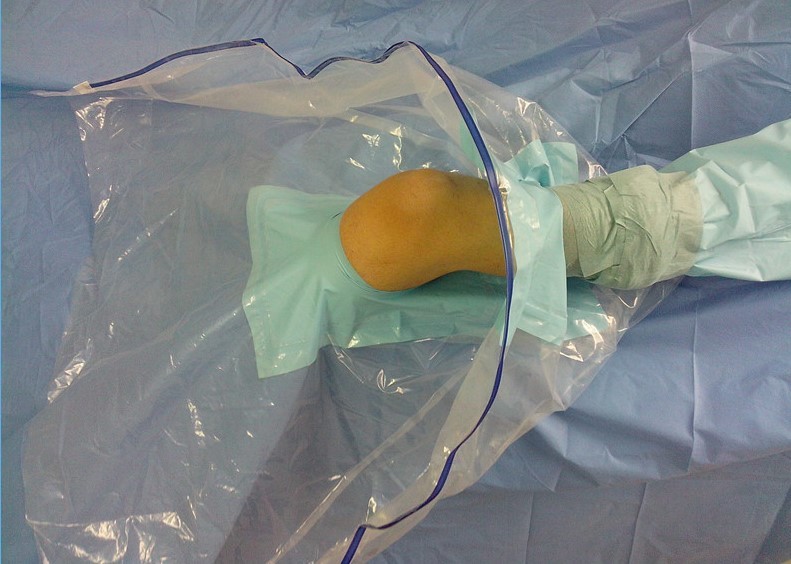  Knee Arthroscopy Disposable Patient Drapes Lower Extremity Orthopedic Class II Manufactures