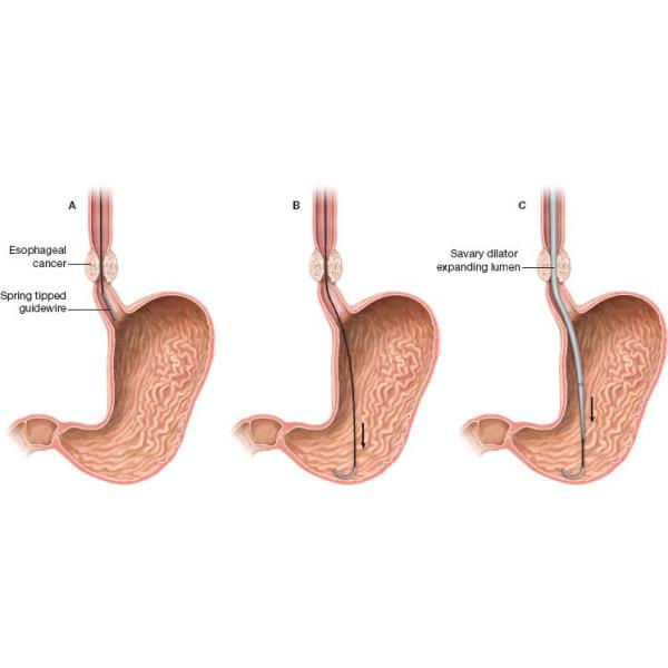 Single Use Medical Savary Medical Dilator Kit For Esophagus