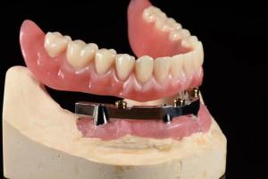 China Titanium Implant Supported Dentures Precise Ivoclar Denture Over Implants on sale