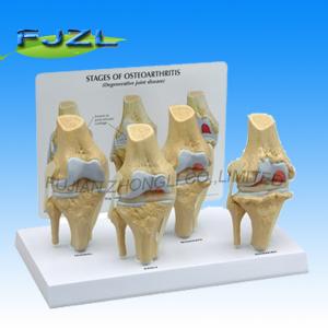  4-Stage Osteo-Arthritic Knee Anatomical Model Anatomical Model Manufactures