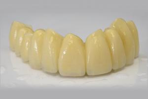 China Dental PMMA Provisional Crown Translucency Esthetic IPS E Max Crown on sale