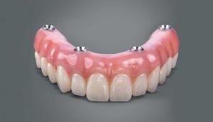 China Dental All On 4 Implant Supported Dentures Professional Natural Looking on sale