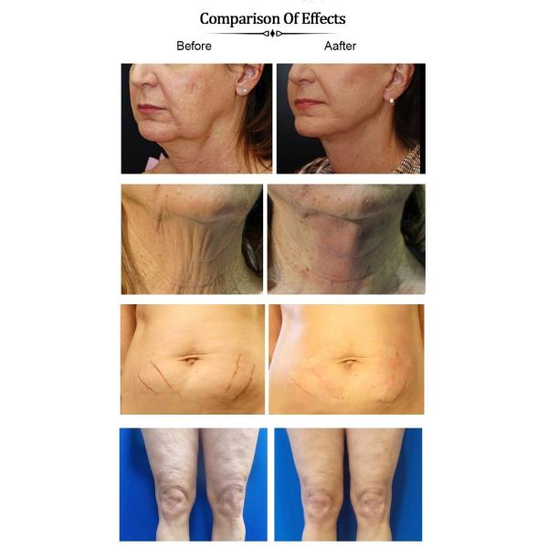 Korea Hilos Tensores Para El Rostro V Line Face Lifting Fio Barbed Mono Screw 3d 4d Cog Pdo Thread