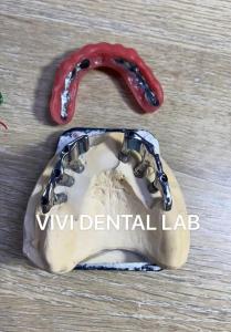 China Precise Bar Implant Supported Hybrid Denture Scheftner Ivoclar Material on sale